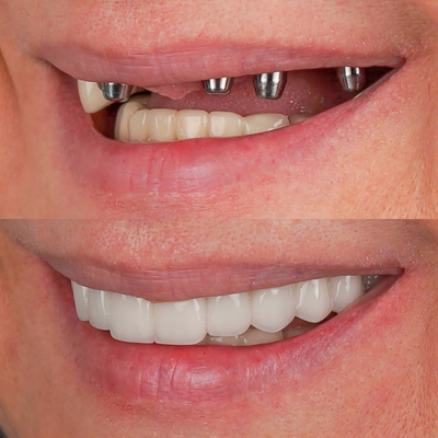 你一定要知道的超詳細種牙流程總整理！