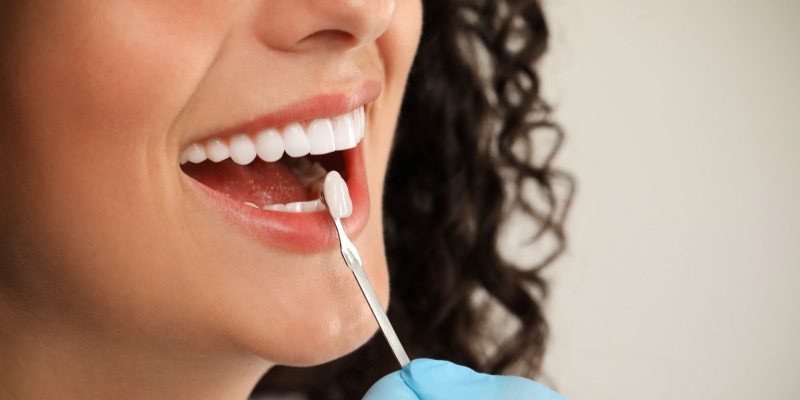 牙齒美白、補牙就靠「它」?牙貼片讓你輕鬆展現亮白笑容 牙齒美白、補牙就靠「它」?牙貼片讓你輕鬆展現亮白笑容