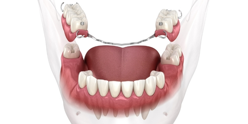 活動假牙種類、優缺點與保養方式完整解析，找回最靚的笑容！