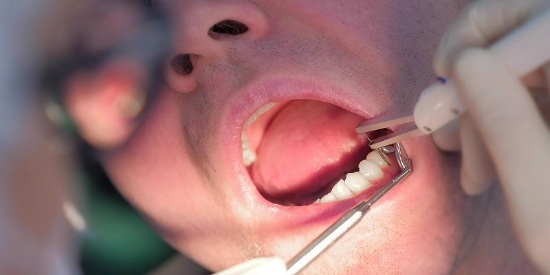 牙周袋是什麼？深入了解與牙周病之間的關係，掌握治療關鍵！