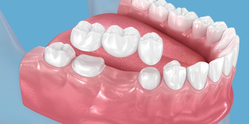 鑲牙好唔好？缺牙治療唔好拖，鑲假牙方案快手比較畀你睇！