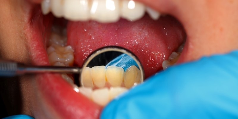 牙結石是什麼?口臭、牙齦紅腫小心牙石在作怪,預防看這篇! 牙結石是什麼?口臭、牙齦紅腫小心牙石在作怪,預防看這篇!