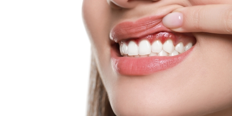 牙齦發炎怎麼辦？不可不知的口腔警訊，牙肉發炎恐成牙周病！