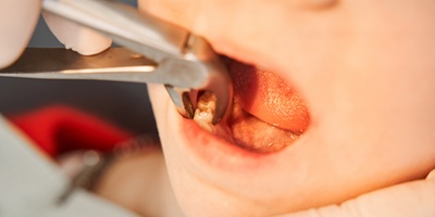 剝牙痛唔痛？牙齒健康照護不馬虎，脫牙價錢、流程全整理！