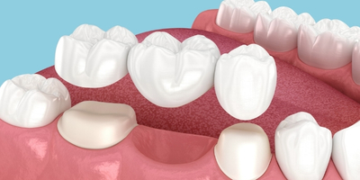 缺牙治療不能拖！掌握牙橋種類、材質與優勢，選對假牙方案