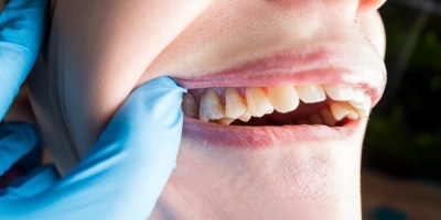 牙肉萎縮怎麼辦 萎縮成因一次看 日常照護keep住牙齦健康