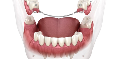 活動假牙種類、優缺點與保養方式完整解析，找回最靚的笑容！