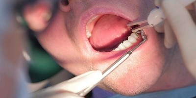 牙周袋是什麼？深入了解與牙周病之間的關係，掌握治療關鍵！(1)