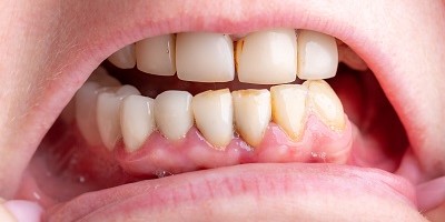 牙周病治療要幾耐？搞清楚4大階段症狀，正確養護先唔會再發！(1)