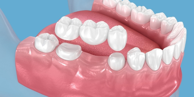 鑲牙好唔好？缺牙治療唔好拖，鑲假牙方案快手比較畀你睇！