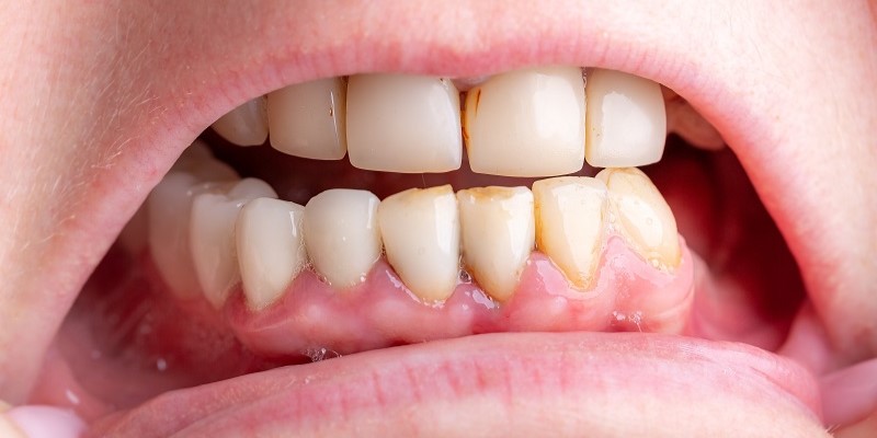牙周病治療要幾耐？搞清楚4大階段症狀，正確養護先唔會再發！